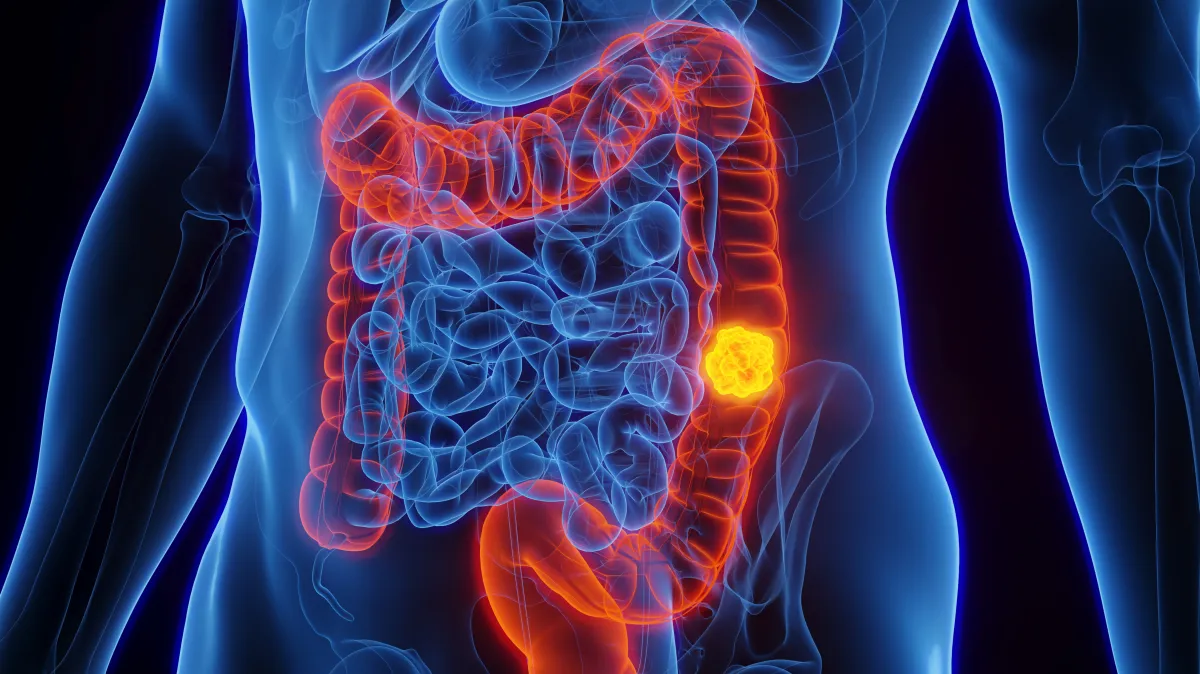 Cancer Rates Rise in Younger People