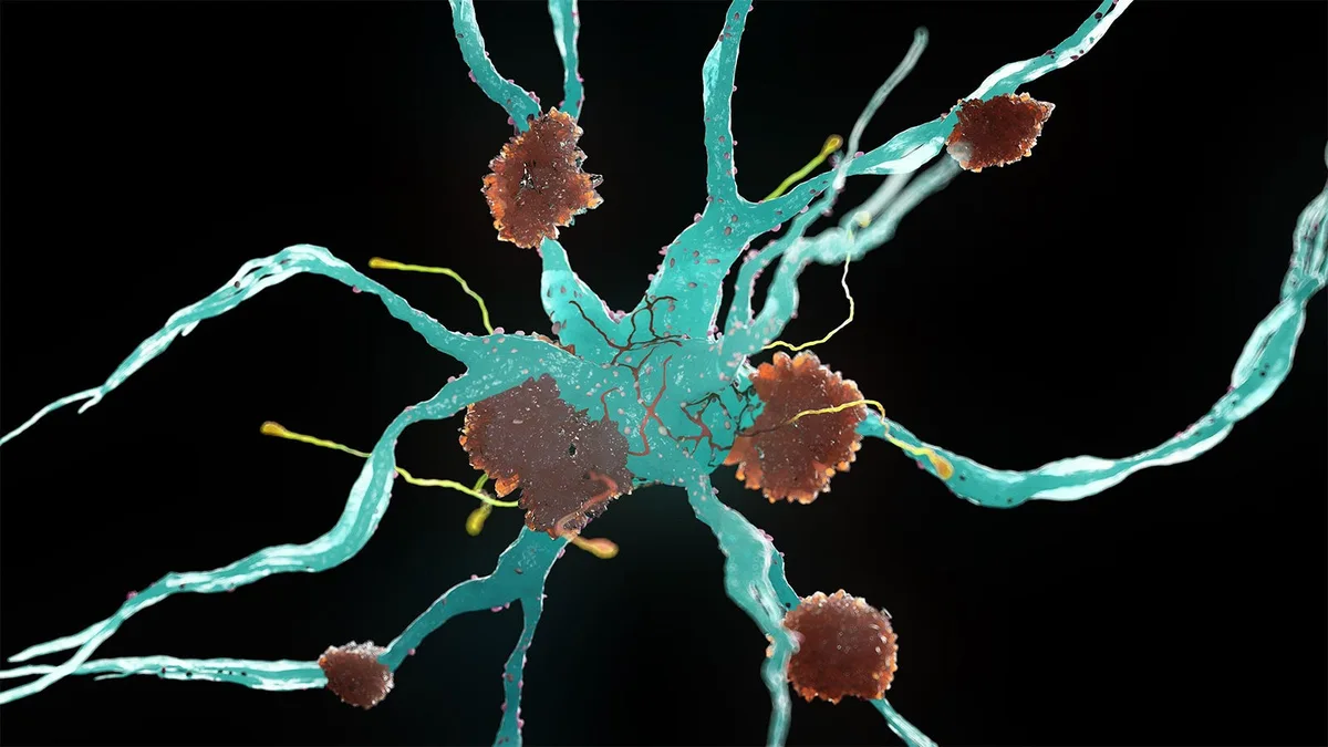 ADHD Linked to Higher Dementia Risk
